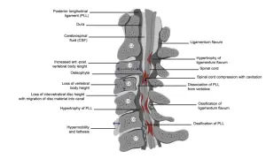 Sagittalsnitt av ryggmärgen visar orsaker till cervikalgi och sjukskrivning, som spinal stenos och ligamentförändringar.