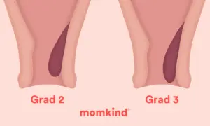 Illustrationer visar olika grader av framfall i underlivet hos gravida. Från grad 1 till 4, där framfallet blir mer uttalat.