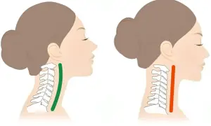 Illustration visar en halsryggrad med en grön markering som indikerar en normal kurva, och en röd markering som visar en rakare nacke, potentiellt relaterat till cervikal spondylos.