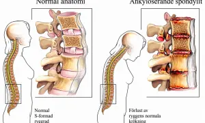 Jämförelse av normal rygg med spondylos. Bilden visar hur spondylos kan leda till stelhet och förlust av ryggens naturliga krökning.