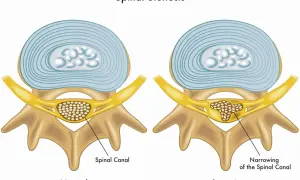 Illustration visar normal ryggkota och en med cervikal stenos, där spinalkanalen är förträngd.