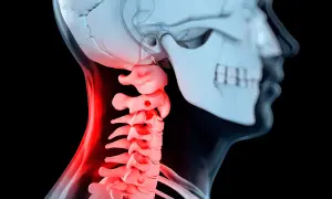 Illustration av en mänsklig halsryggrad med inflammation, som visar potentiella problem vid artros i nacken operation.