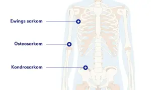 Illustration av skelettet med markeringar för Ewings sarkom, osteosarkom och kondrosarkom. Ont i skulderbladet kan vara relaterat till dessa cancerformer.