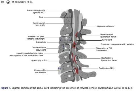 Sagittalsnitt av ryggmärgen visar orsaker till cervikalgi och sjukskrivning, som spinal stenos och ligamentförändringar.