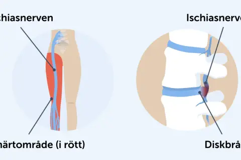 Illustrationer visar iskiasnerven och ett diskbråck som kan orsaka ont mellan skinkorna.