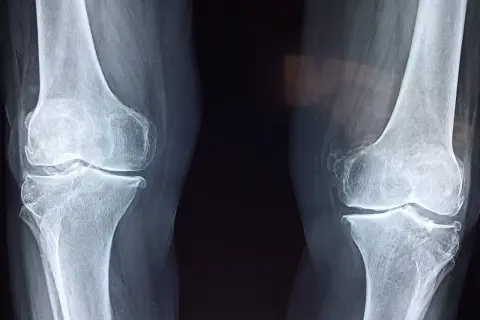 Röntgenbilder av knän visar tecken på artros, vilket kan orsaka ont i leder vid graviditet.