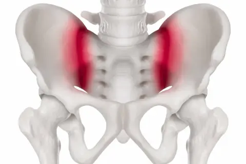 Skelettet visar bäckenet med markerad smärta i höftlederna, vilket kan vara relaterat till foglossning rumpa.