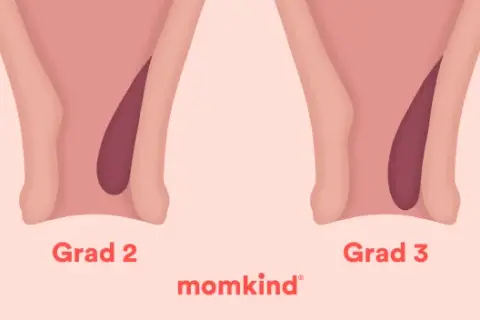 Illustrationer visar olika grader av framfall i underlivet hos gravida. Från grad 1 till 4, där framfallet blir mer uttalat.