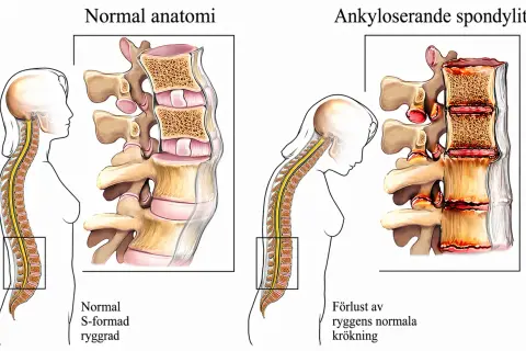 Jämförelse av normal rygg med spondylos. Bilden visar hur spondylos kan leda till stelhet och förlust av ryggens naturliga krökning.