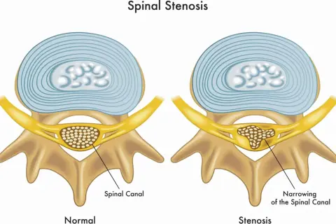 Illustration visar normal ryggkota och en med cervikal stenos, där spinalkanalen är förträngd.