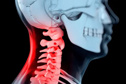 Illustration av en mänsklig halsryggrad med inflammation, som visar potentiella problem vid artros i nacken operation.