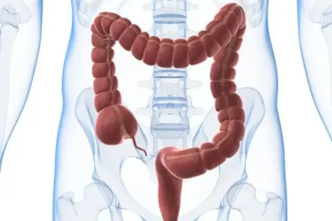 En illustration av tjocktarmen, med dess segmenterade utseende. Kan vara relevant vid undersökning av psoas tecken.