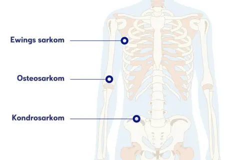 Illustration av skelettet med markeringar för Ewings sarkom, osteosarkom och kondrosarkom. Ont i skulderbladet kan vara relaterat till dessa cancerformer.