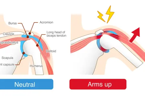 Illustration visar axelns anatomi i neutralt läge och med armen uppåt. Vid armrörelse syns klämning och smärta, typiska inflammation i axeln symtom.