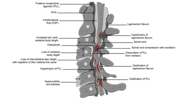 Sagittalsnitt av ryggmärgen visar orsaker till cervikalgi och sjukskrivning, som spinal stenos och ligamentförändringar.