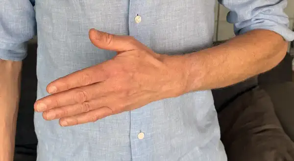 En man i ljusblå skjorta visar sin ont ovansida hand.