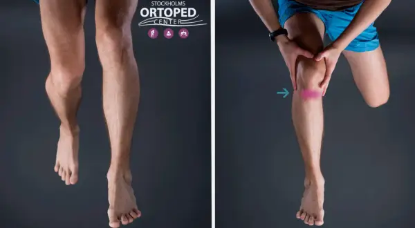 Två bilder visar en mans ben. Till vänster syns en tydlig skillnad i längd mellan benen, ett symptom på olika långa ben. Till höger visas ett knä med en rosa markering, som indikerar smärta.
