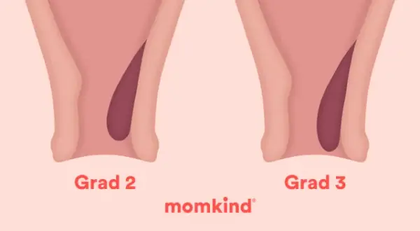 Illustrationer visar olika grader av framfall i underlivet hos gravida. Från grad 1 till 4, där framfallet blir mer uttalat.