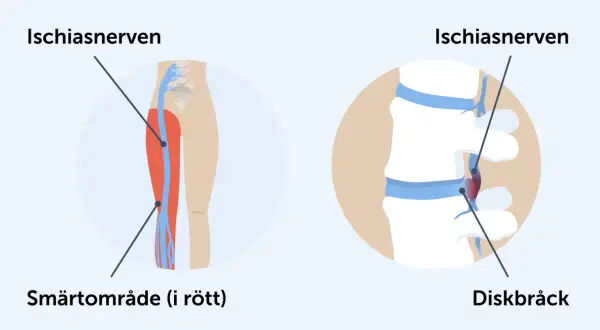 Illustrationer visar var ischiasnerven sitter, dess smärtområde i benet och hur ett diskbråck kan påverka den.