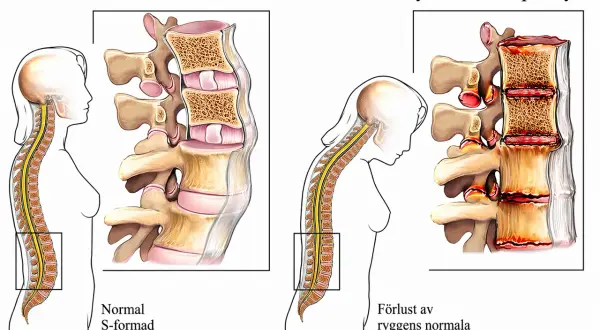 Jämförelse av normal rygg med spondylos. Bilden visar hur spondylos kan leda till stelhet och förlust av ryggens naturliga krökning.