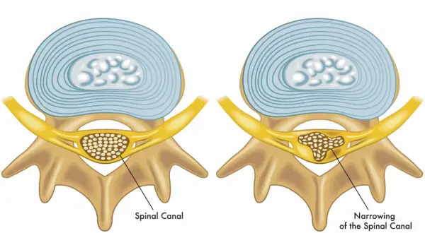 Illustration visar normal ryggkota och en med cervikal stenos, där spinalkanalen är förträngd.
