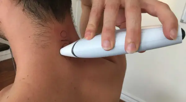 Behandling av diskbråck i nacken med en vit apparat. En hand håller apparaten mot nacken där en markering syns.