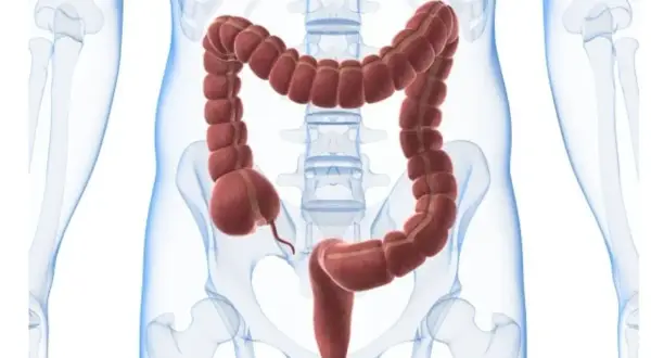 En illustration av tjocktarmen, med dess segmenterade utseende. Kan vara relevant vid undersökning av psoas tecken.