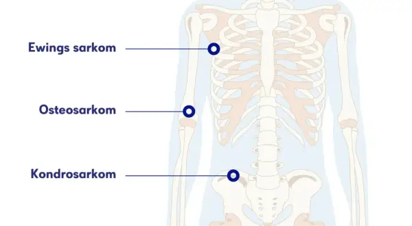 Illustration av skelettet med markeringar för Ewings sarkom, osteosarkom och kondrosarkom. Ont i skulderbladet kan vara relaterat till dessa cancerformer.