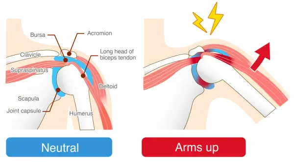 Illustration visar axelns anatomi i neutralt läge och med armen uppåt. Vid armrörelse syns klämning och smärta, typiska inflammation i axeln symtom.