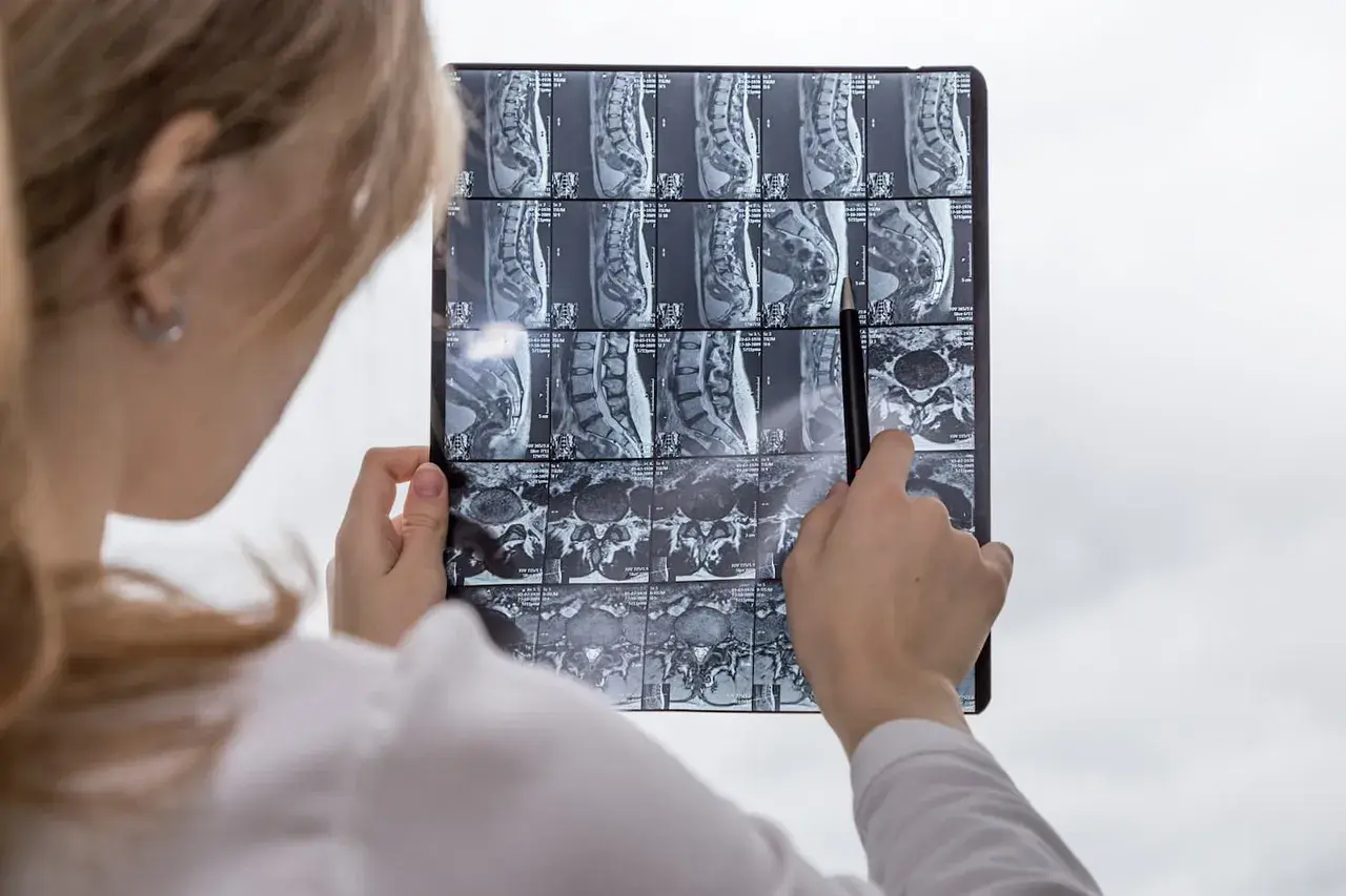 Läkare undersöker MR-bilder av ryggraden, pekar på en möjlig protrusion.