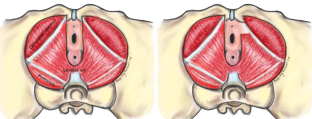 Illustration av bäckenbottenmuskler. Kan hjälpa förståelse vid ont i sittbenet.