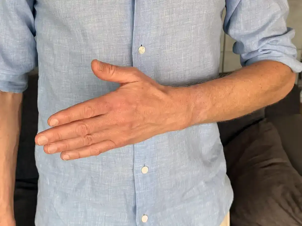 En man i ljusblå skjorta visar sin ont ovansida hand.