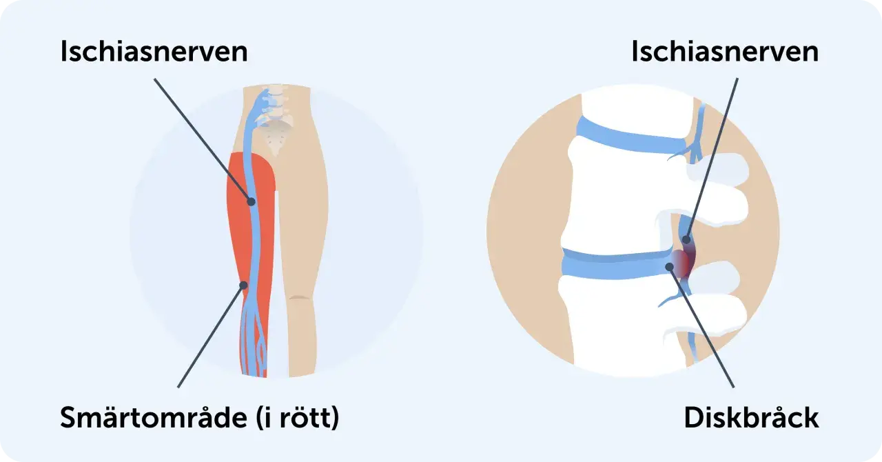 Illustrationer visar var ischiasnerven sitter, dess smärtområde i benet och hur ett diskbråck kan påverka den.