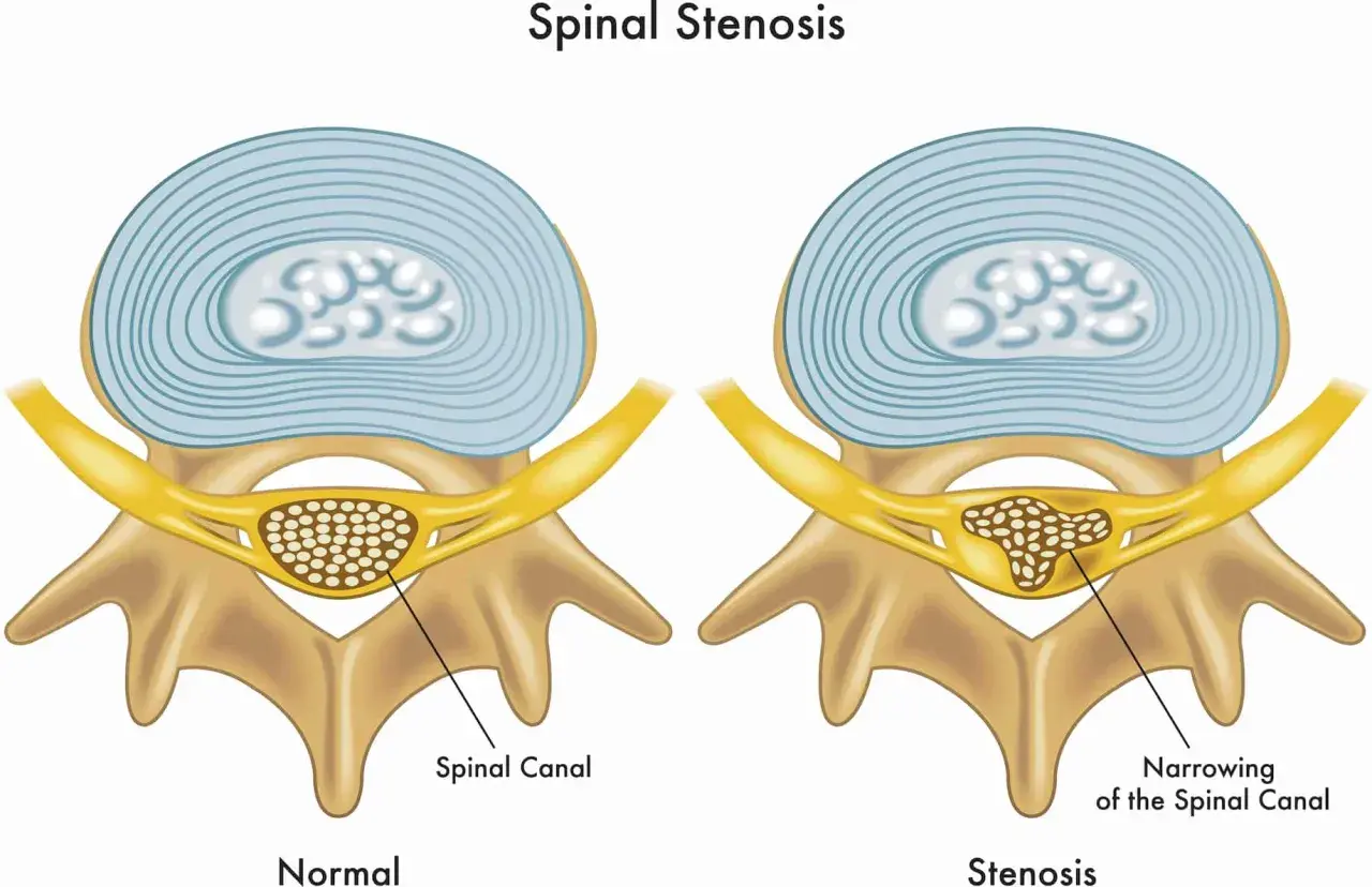 Illustration visar normal ryggkota och en med cervikal stenos, där spinalkanalen är förträngd.
