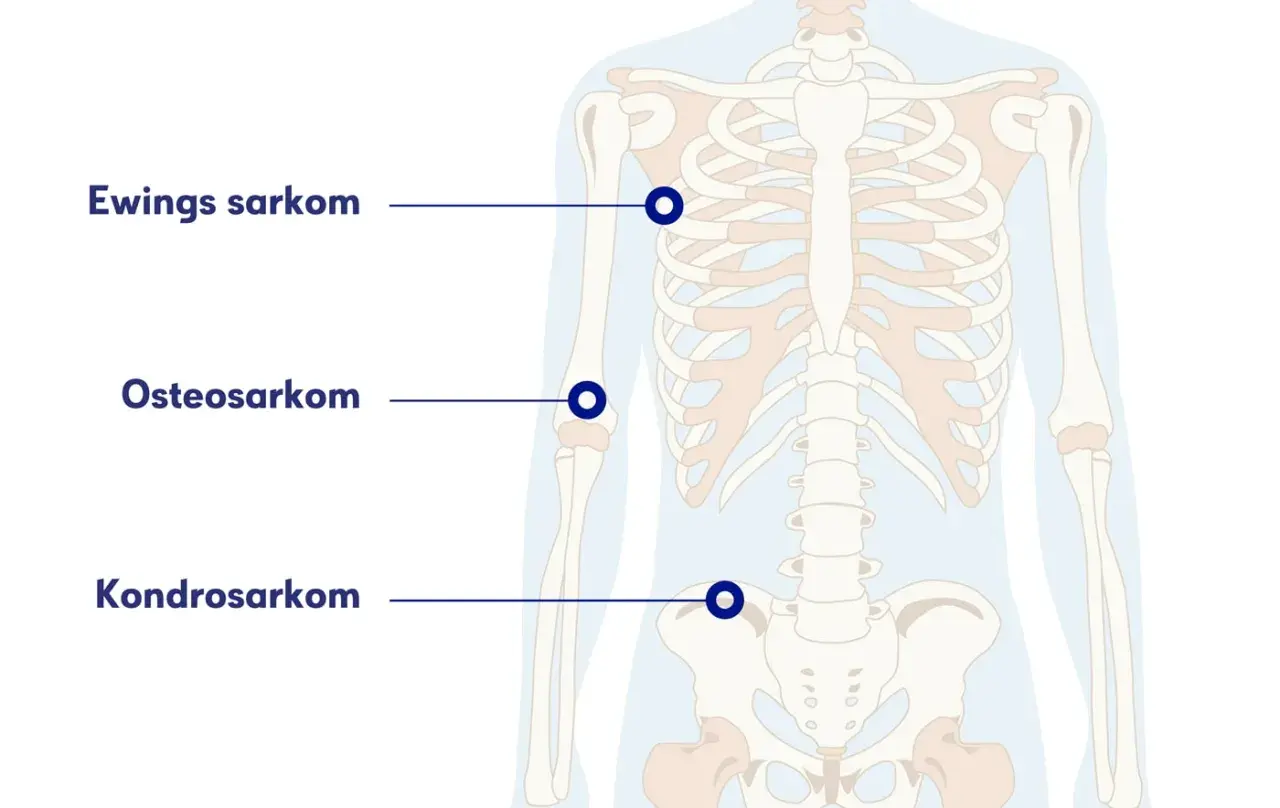 Illustration av skelettet med markeringar för Ewings sarkom, osteosarkom och kondrosarkom. Ont i skulderbladet kan vara relaterat till dessa cancerformer.