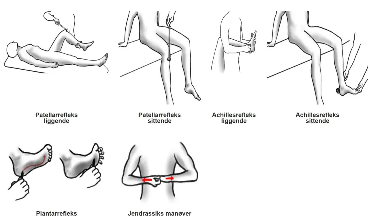 Illustrationer visar tester f&ouml;r patellar-, Achilles- och plantarrefl exer, samt Jendrassiks man&ouml;ver. Kan indikera inga reflexer i benen.