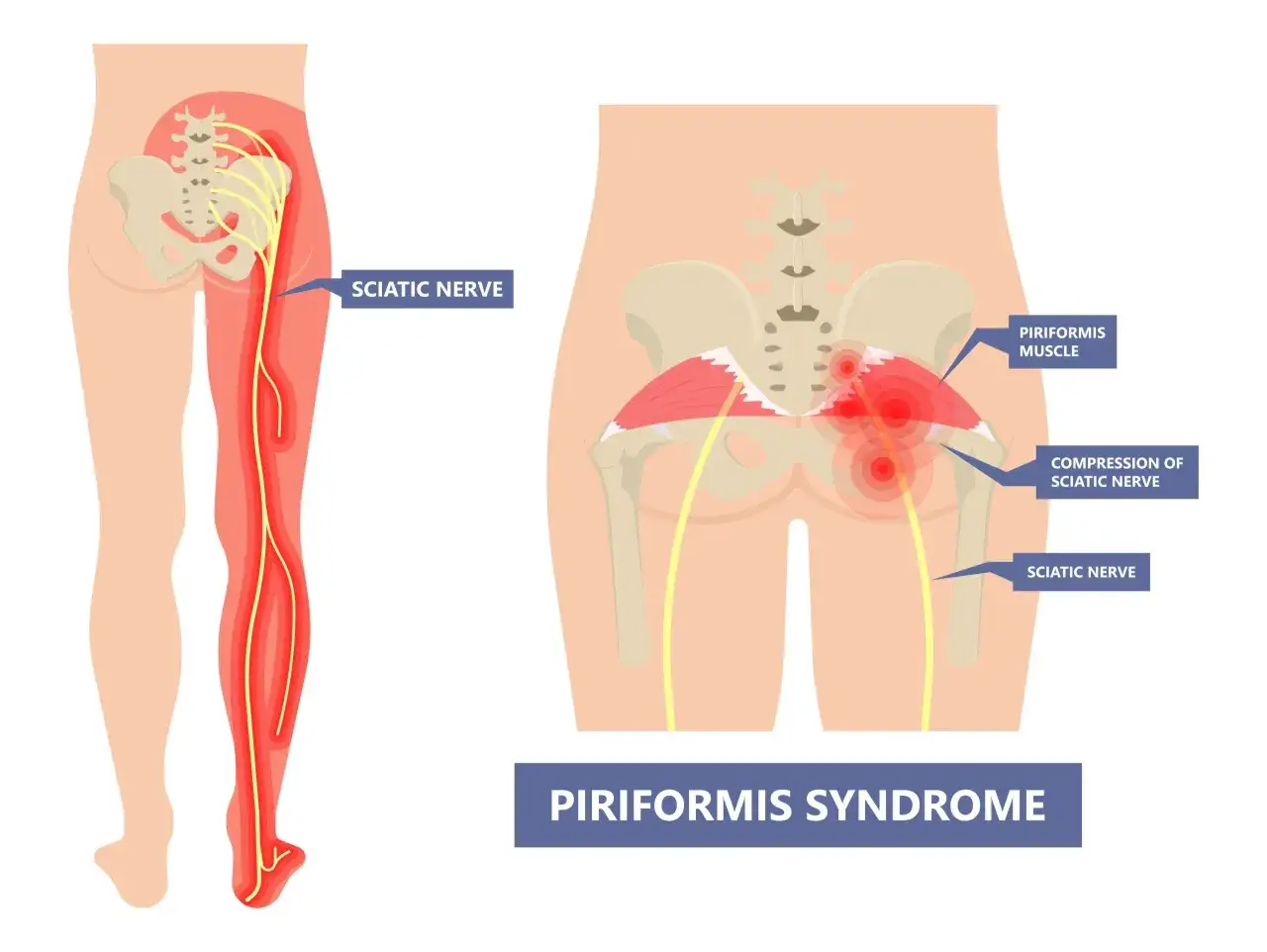 Illustration visar piriformis syndrom, där piriformismuskeln trycker på ischiasnerven och orsakar smärta i benet.