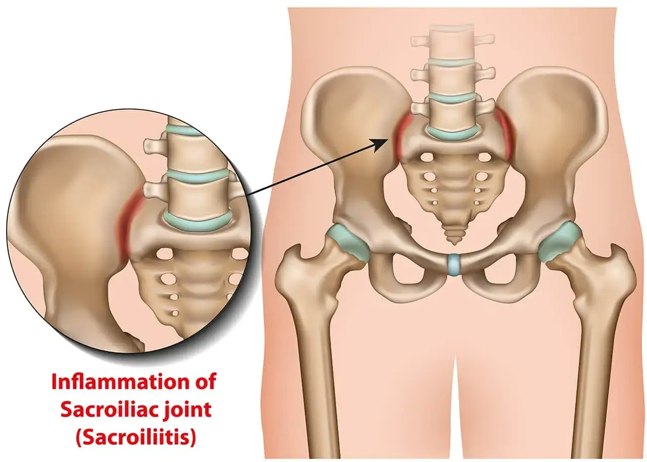 Illustration av bäckenet med inflammerade sacroiliacaleder, vilket kan orsaka ont mellan skinkorna. En närbild visar den röda inflammationen.