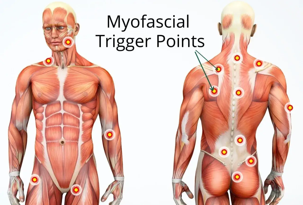 Muskelanatomi visar myofasciella triggerpunkter på fram- och baksidan av kroppen, inklusive benen.
