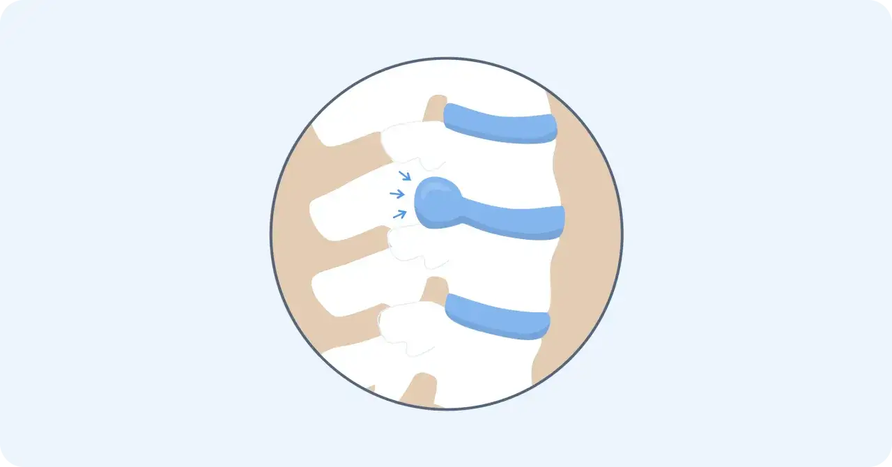 Illustration av en diskbråck i ryggraden, där en blå skiva pressas ut mellan kotorna. Frågan om att operera diskbråck eller inte är central.