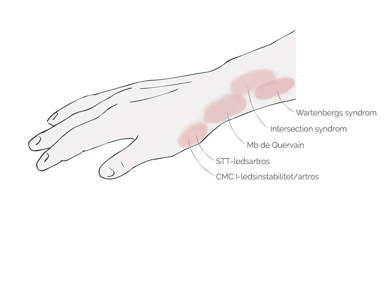 Illustration av ont ovansida hand med markerade områden för Wartenbergs syndrom, Intersection syndrom, Mb de Quervain, STT-ledsartros och CMC I-ledsinstabilitet/artros.