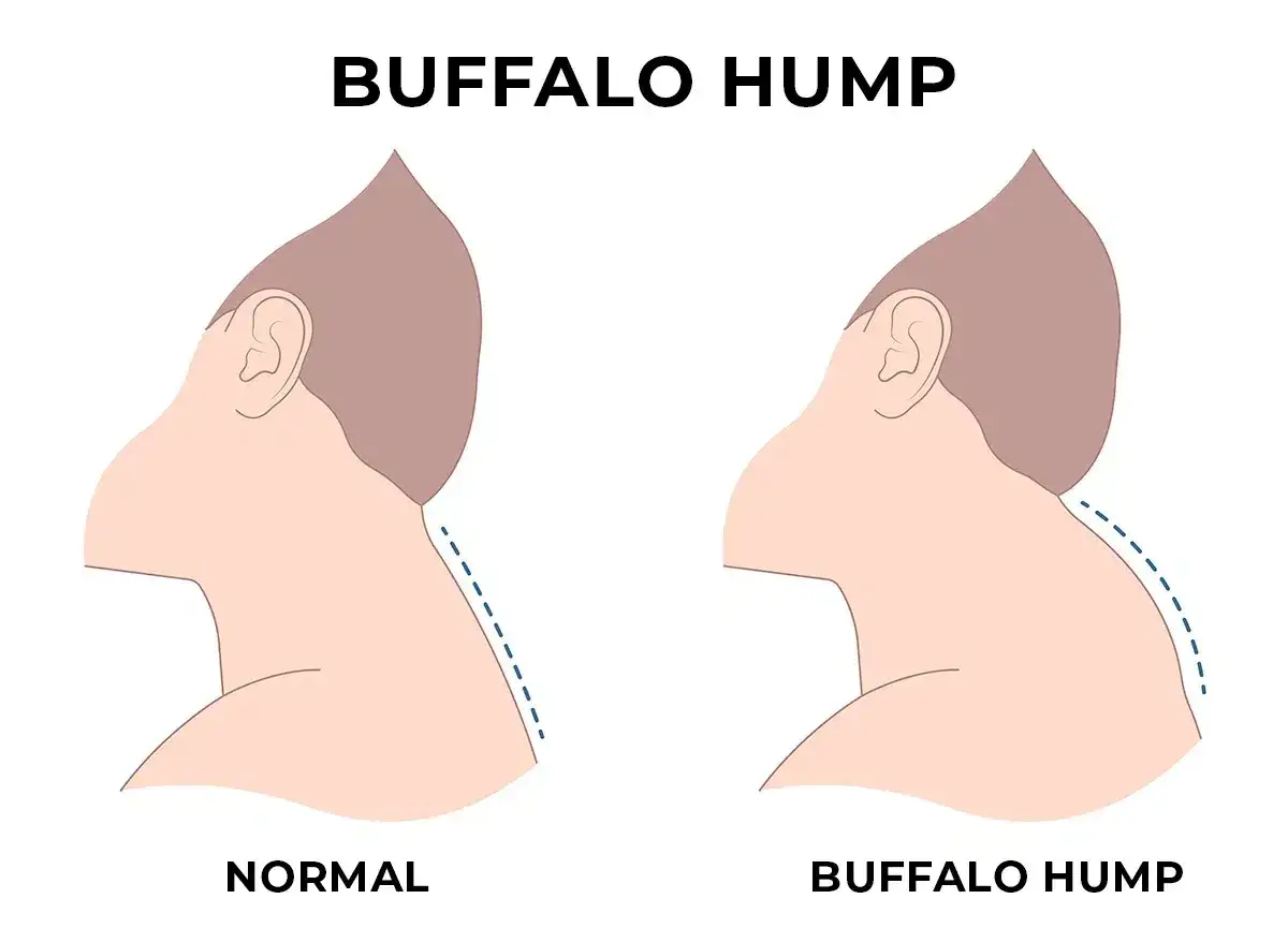 Illustration visar skillnad mellan normal nacke och puckel nacke (buffalo hump).