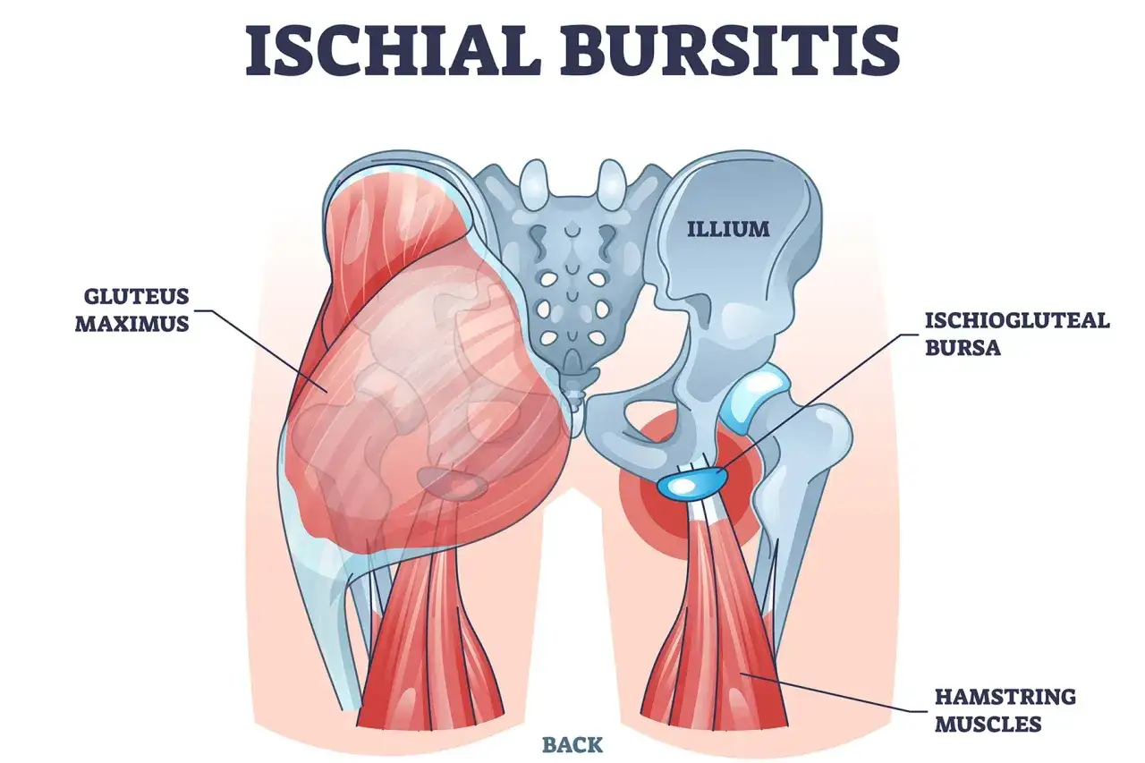 Illustration av bäckenet med gluteus maximus och hamstringsmuskler. Visar ischiogluteal bursan, som kan orsaka ont i sittbenet vid inflammation.