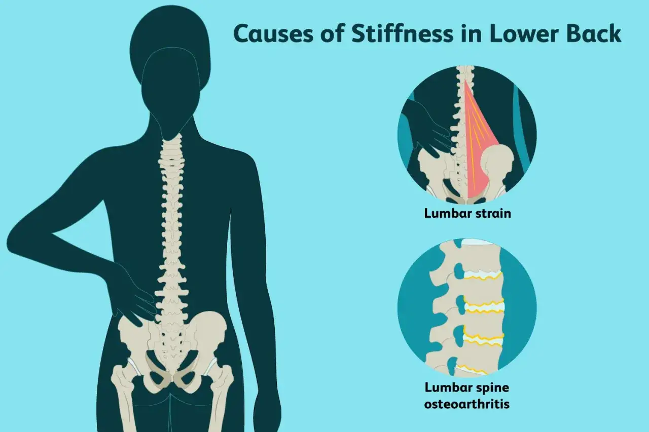 Illustration visar orsaker till stelhet i ländryggen, inklusive lumbal belastning och artros. Reumatism i ryggen kan orsaka dessa besvär.