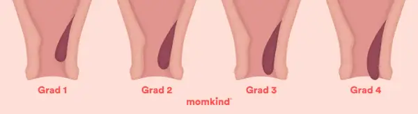 Illustrationer visar olika grader av framfall i underlivet hos gravida. Från grad 1 till 4, där framfallet blir mer uttalat.