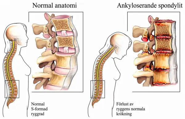 Jämförelse av normal rygg med spondylos. Bilden visar hur spondylos kan leda till stelhet och förlust av ryggens naturliga krökning.