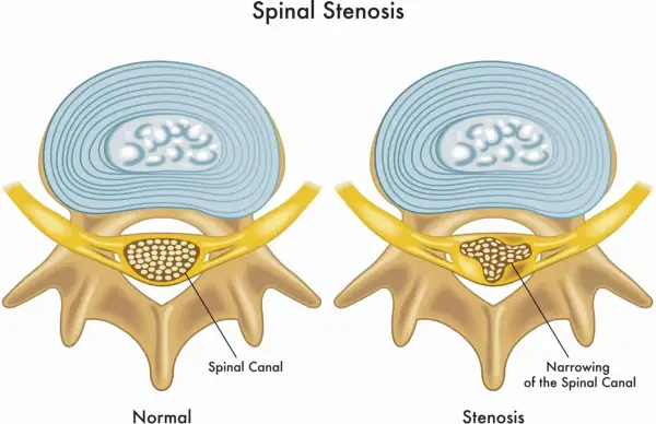 Illustration visar normal ryggkota och en med cervikal stenos, där spinalkanalen är förträngd.