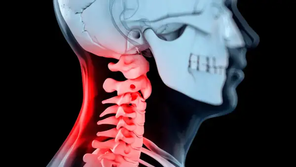 Illustration av en mänsklig halsryggrad med inflammation, som visar potentiella problem vid artros i nacken operation.
