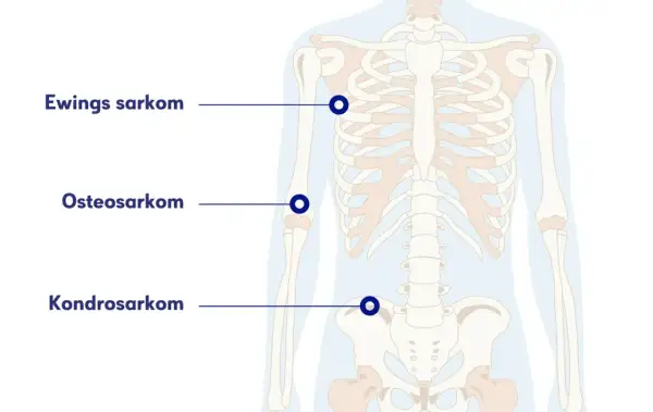 Illustration av skelettet med markeringar för Ewings sarkom, osteosarkom och kondrosarkom. Ont i skulderbladet kan vara relaterat till dessa cancerformer.