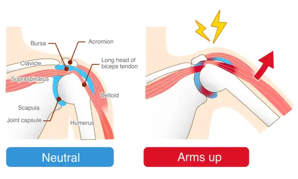 Illustration visar axelns anatomi i neutralt läge och med armen uppåt. Vid armrörelse syns klämning och smärta, typiska inflammation i axeln symtom.